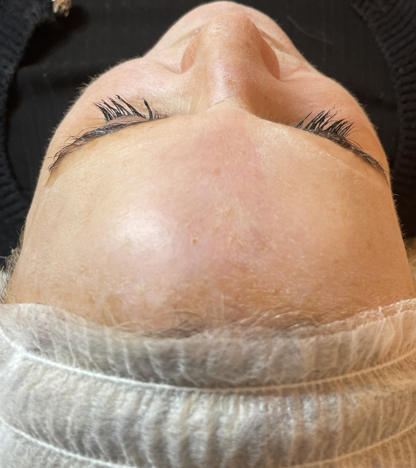 chemical peel before face