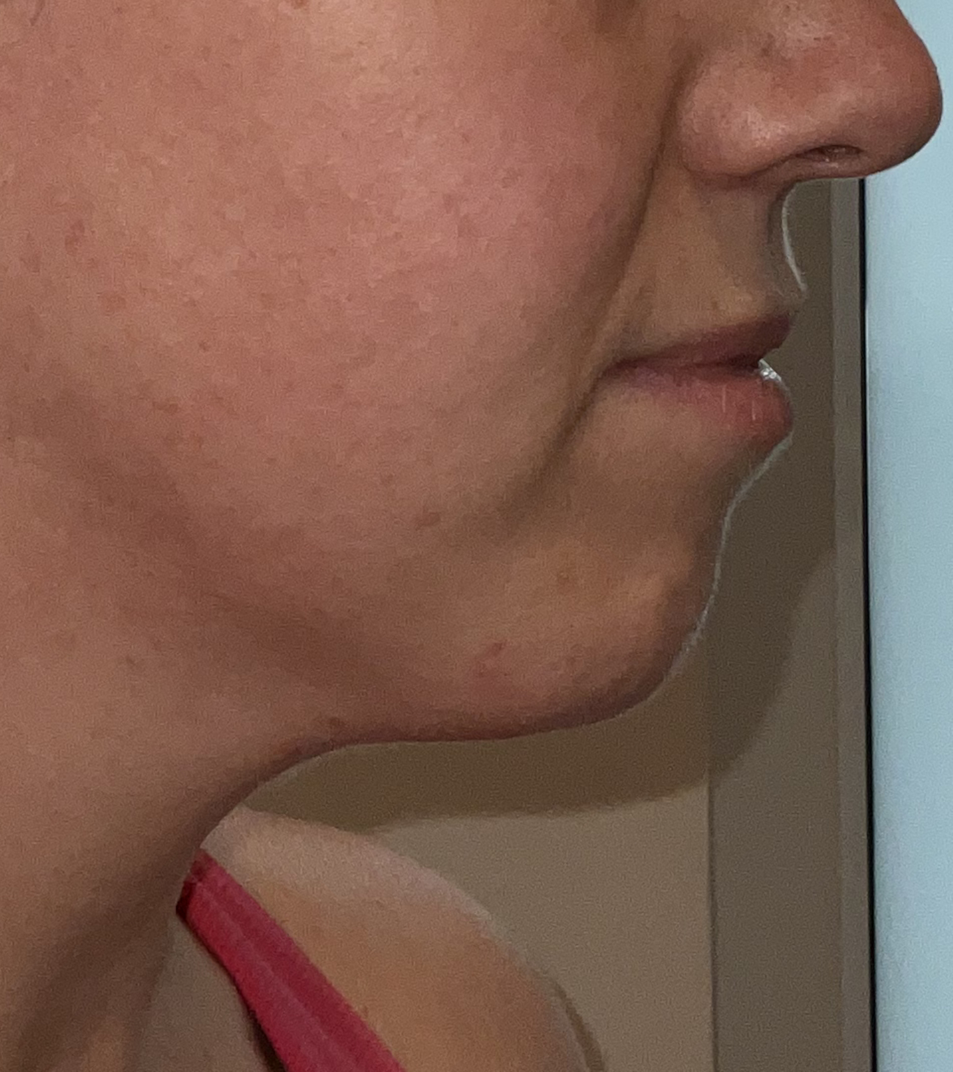chin filler before right profile