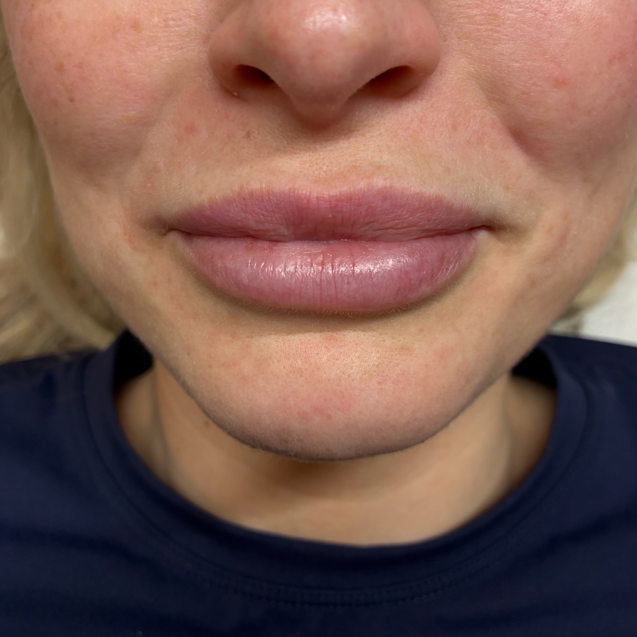 lips five front before