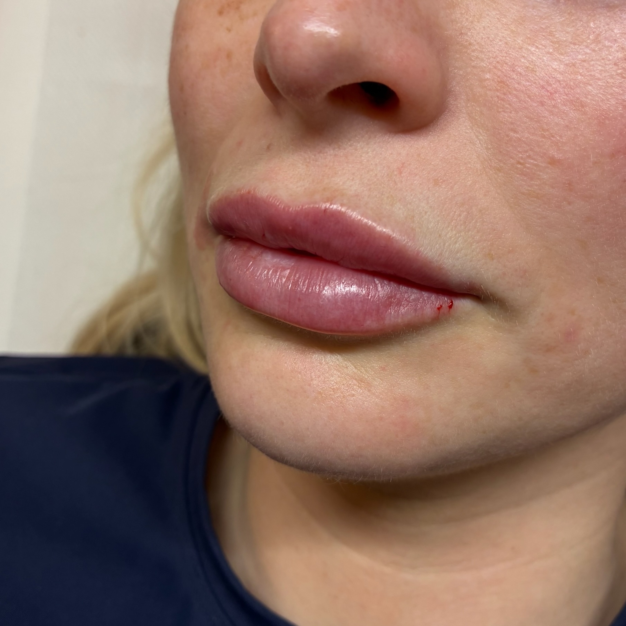 lips five left after