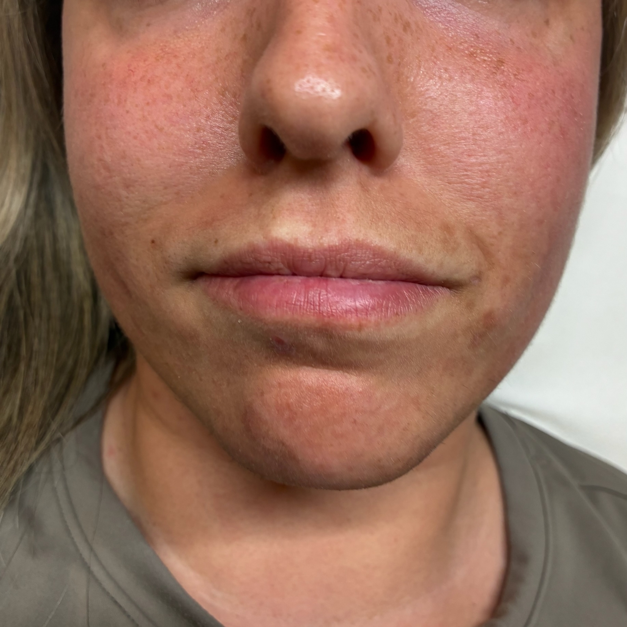 lips four front before
