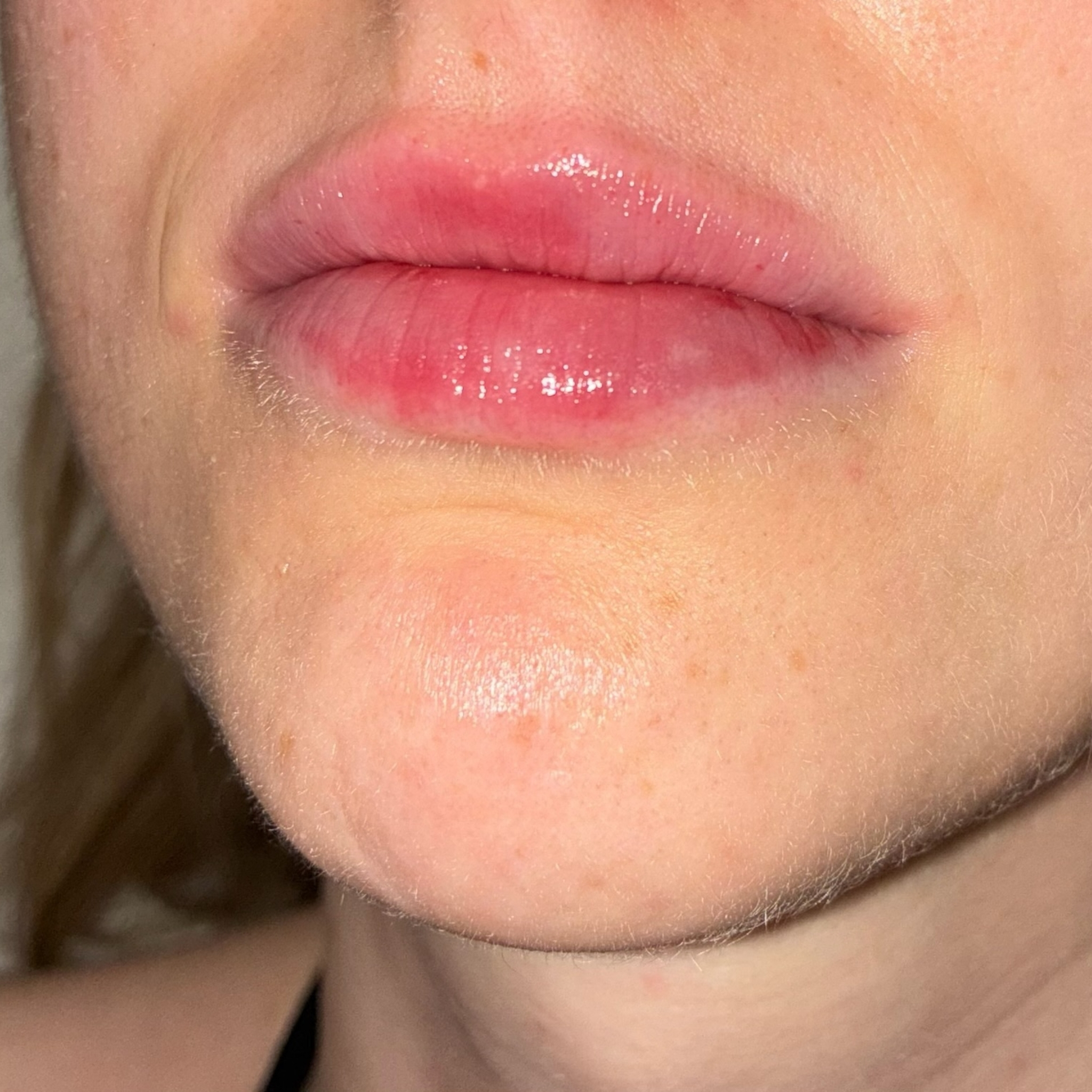 lips nine left after