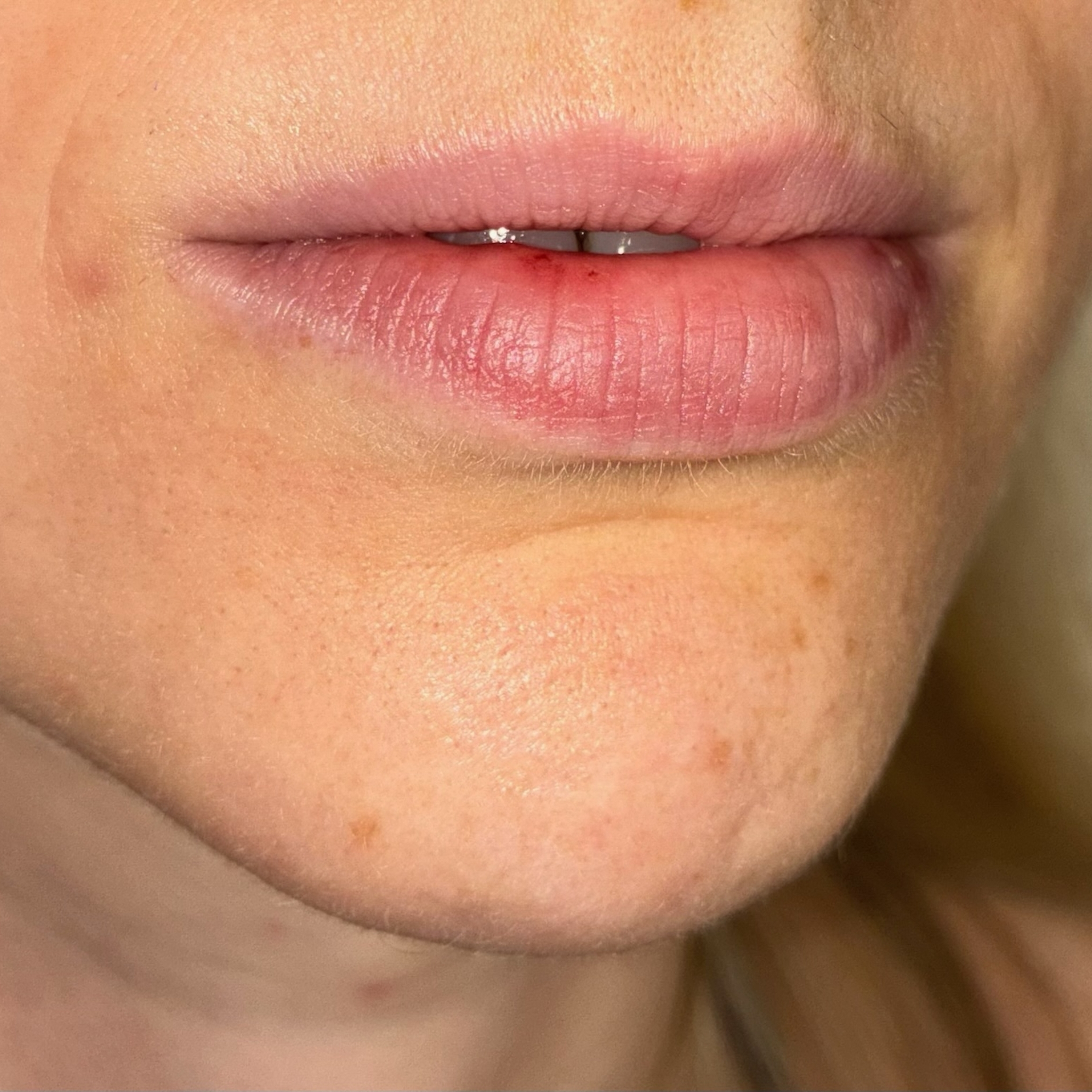 lips nine right before