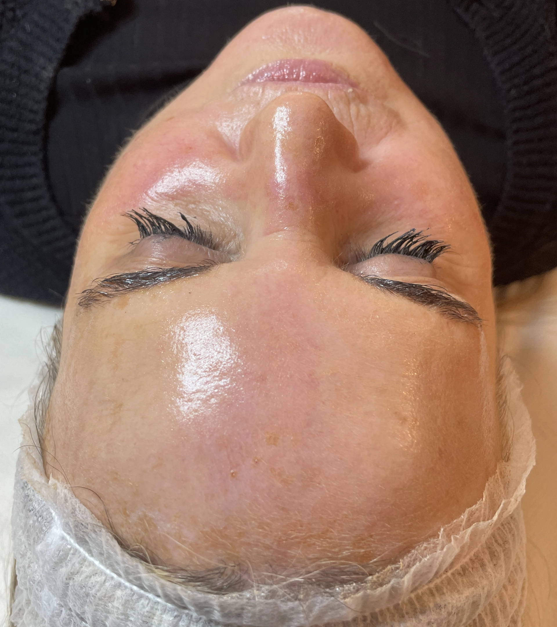 chemical peel after