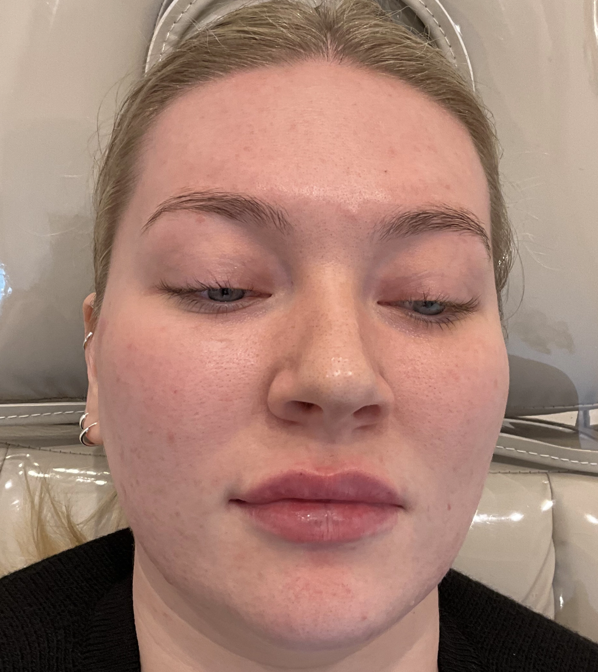 lip filler after front