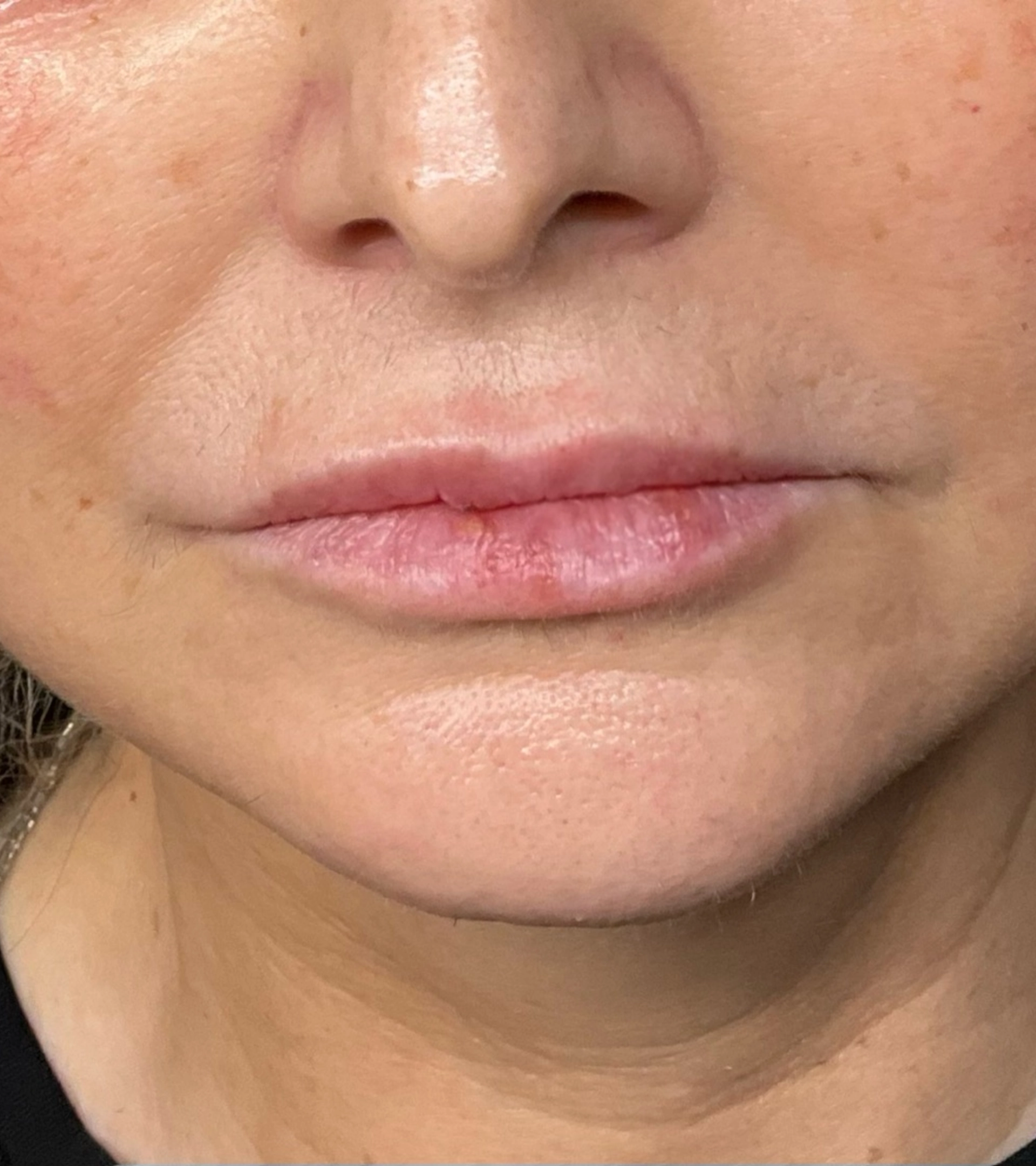 lips four weeks after dissolving